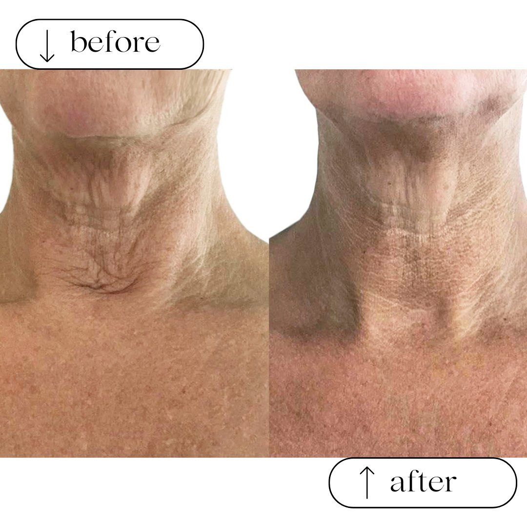 WHY YOUR NECK AND CHEST DESERVE SPECIAL ATTENTION - Cult51
